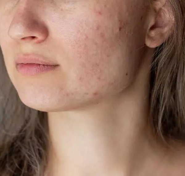 Acne Treatment in Delhi: What Actually Works for Long-Term Results